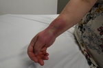 Bruised wrist by Arthur Labatt School of Nursing